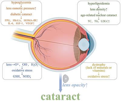 Research progress on the correlation between cataract occurrence and nutrition